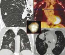 Diagnostica per Immagini in Oncologia: il cancro del polmone